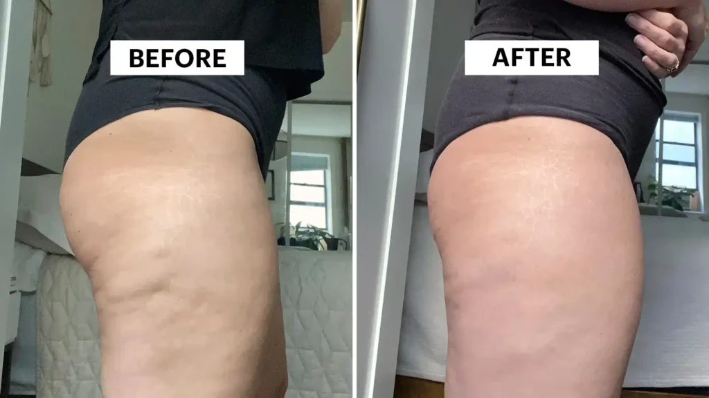 Do Toning Exercise Ramsgate Really Tackle Cellulite?