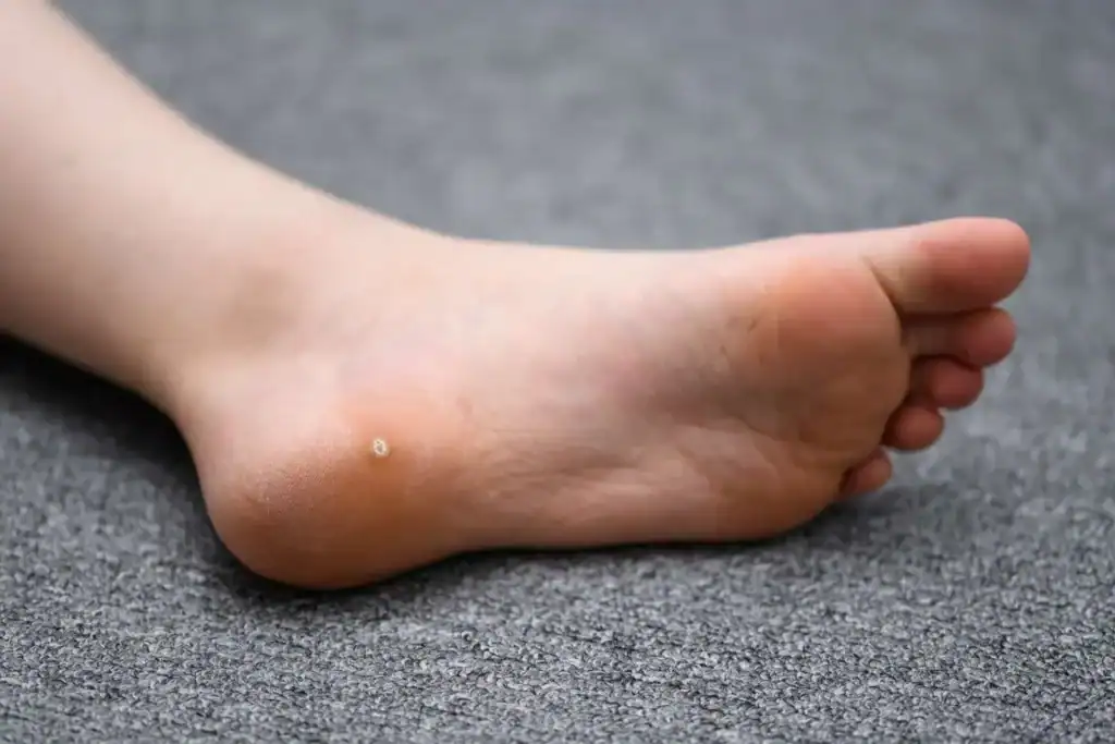 Image of verruca on the bottom of the foot that able to be treated with Cryotherapy Ramsgate