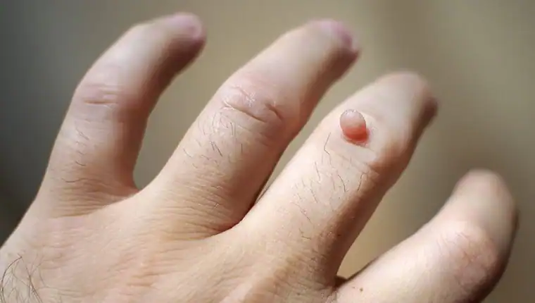 Image of blemish that Cryotherapy Ramsgate can remove with Lipo 360.