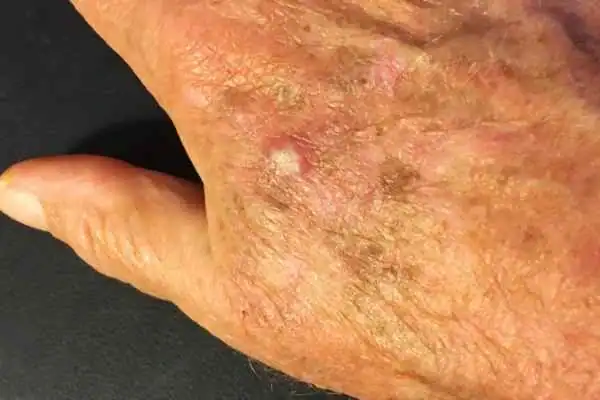 Image of Actinic keratoses Ramsgate on a person hand