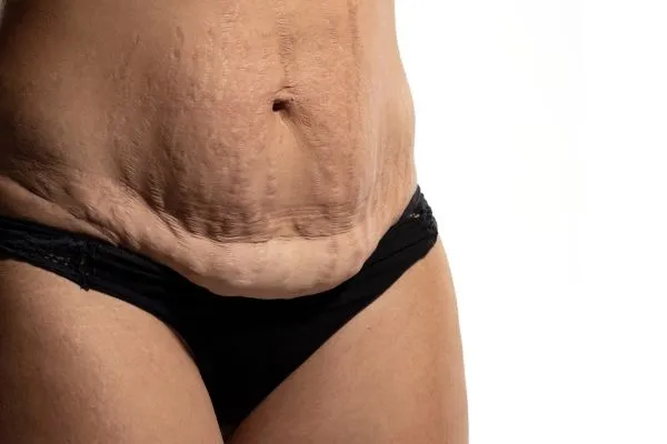 The science behind skin tightening Ramsgate picture of a woman's sagging skin on the stomach